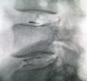 Implantacja DISCOGELu® w uszkodzony dysk.